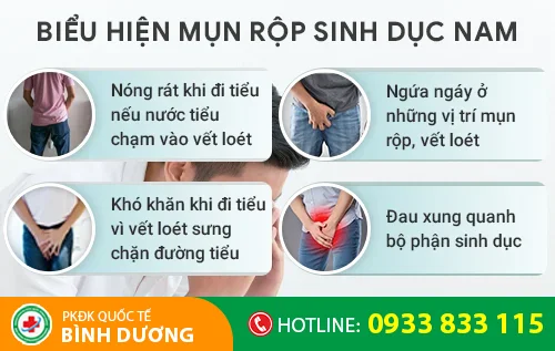 bieu hien benh mun rop sinh duc nam gioi