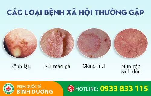 cac benh xa hoi thuong gap