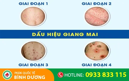 cac giai doan benh giang mai