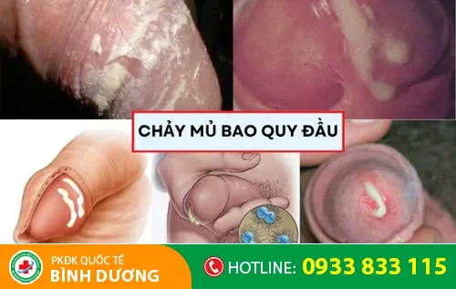 dau hieu bao quy dau chay mu