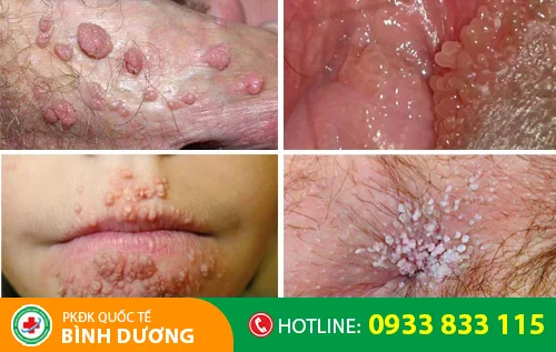 sui mao ga tren cac bo phan co the